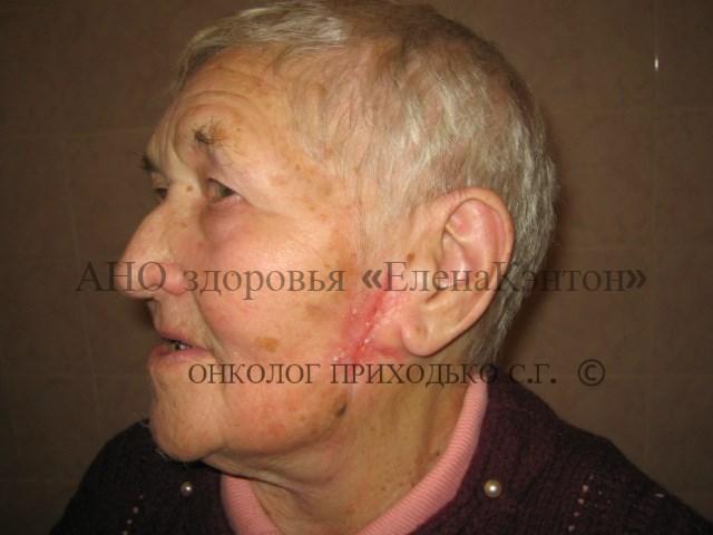 Базалиома на лице