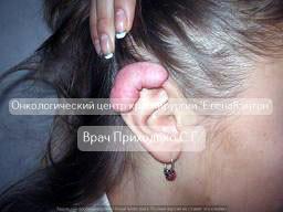 Базалиома лица