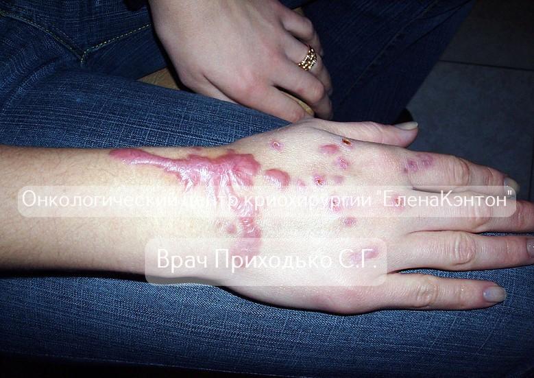 Базалиома лица