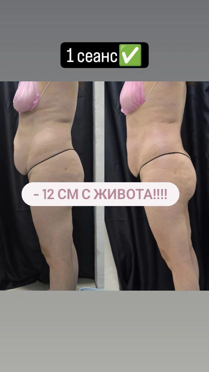 Результаты До и После процедуры